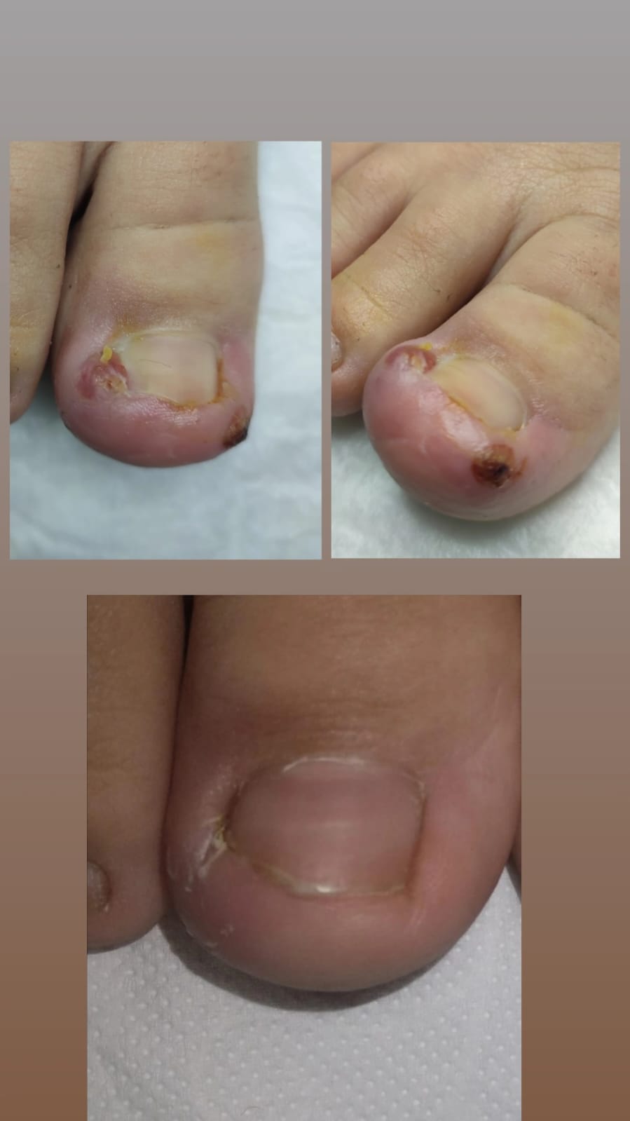 BATIK TIRNAK TEDAVİSİNDE NİCEA PODOLOJİ EKİBİ OLARAK NELER YAPIYORUZ? - Resim 2